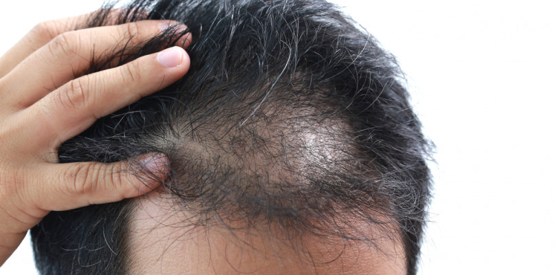 Minoksydyl i Saw Palmetto - pomoc w leczeniu łysienia